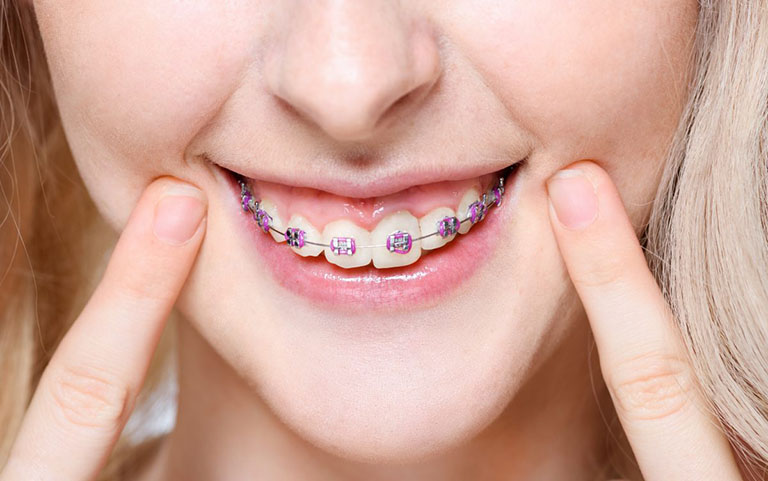 Niềng răng mắc cài có chi phí thấp, phù hợp với người có nhiều khuyết điểm nên được dùng phổ biến hơn