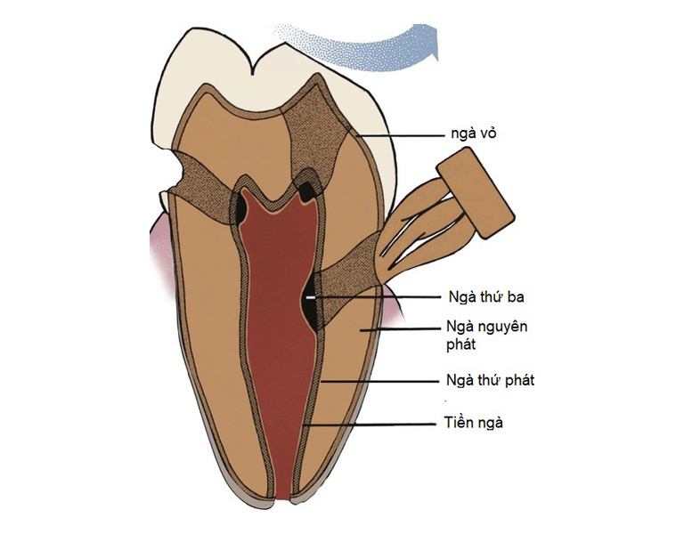 Ngà răng nguyên phát