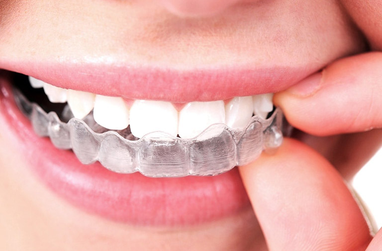 Niềng răng 3D Clear và Invisalign