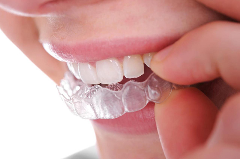 Chi phí niềng răng Invisalign cao hơn so với 3D Clear