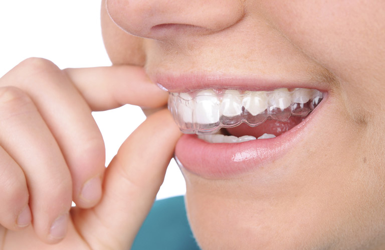 Nên niềng răng 3D Clear hay Invisalign còn phụ thuộc vào khả năng chi trả chi phí 