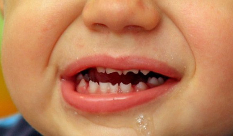 Bề mặt của răng bị lõm hình bán nguyệt