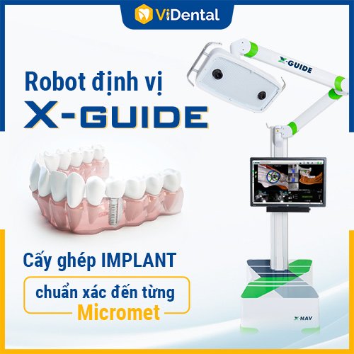 ViDental ứng dụng công nghệ hiện đại vào cấy ghép Implant