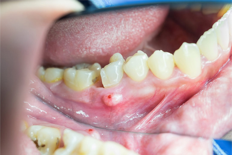Nhiễm trùng răng
