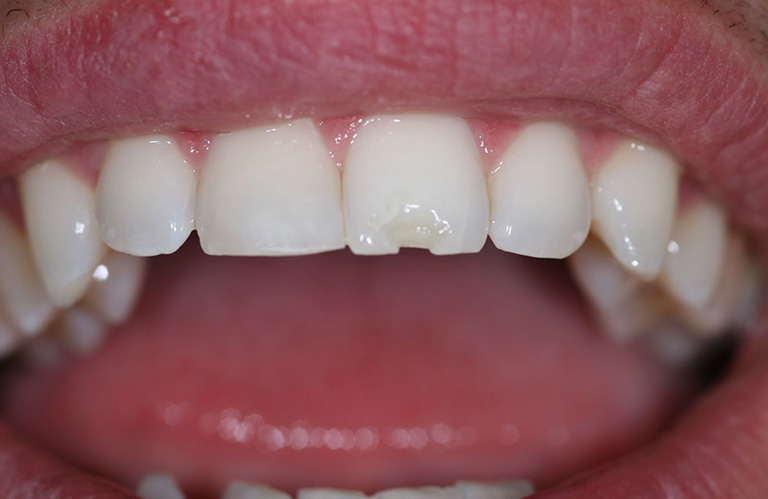 Răng bị mẻ gây ra một điểm lõm sâu