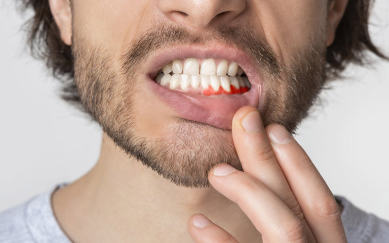 Bọc răng sứ bị nhiễm trùng gây sưng và tấy đỏ ở nướu