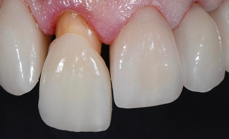 Mão răng sứ không khít với răng thật tạo điều kiện cho vi khuẩn phát triển