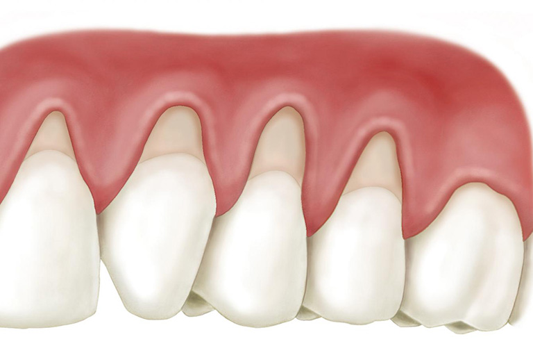 Tụt nướu răng tạo điều kiện cho mảng bám tích tụ dẫn đến sâu răng và nhiễm trùng sau bọc sứ