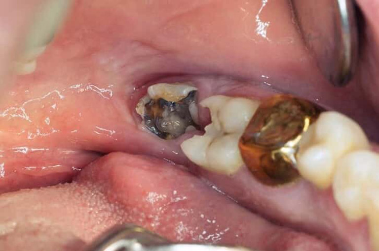 Sâu răng không được điều trị dẫn đến viêm tủy răng khôn