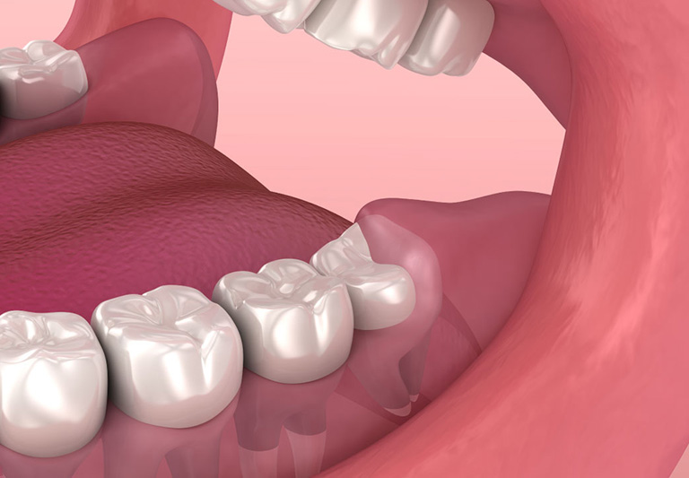 Điều trị tủy răng mang đến hiệu quả cao nhất cho những chiếc răng khôn mọc thẳng
