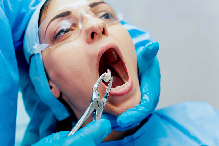 Tiến hành nhổ răng nếu răng khôn mọc lệch, không thể điều trị tủy răng