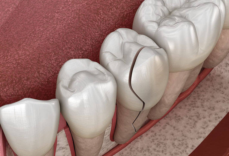 Răng lấy tủy bị vỡ do răng không được nuôi dưỡng