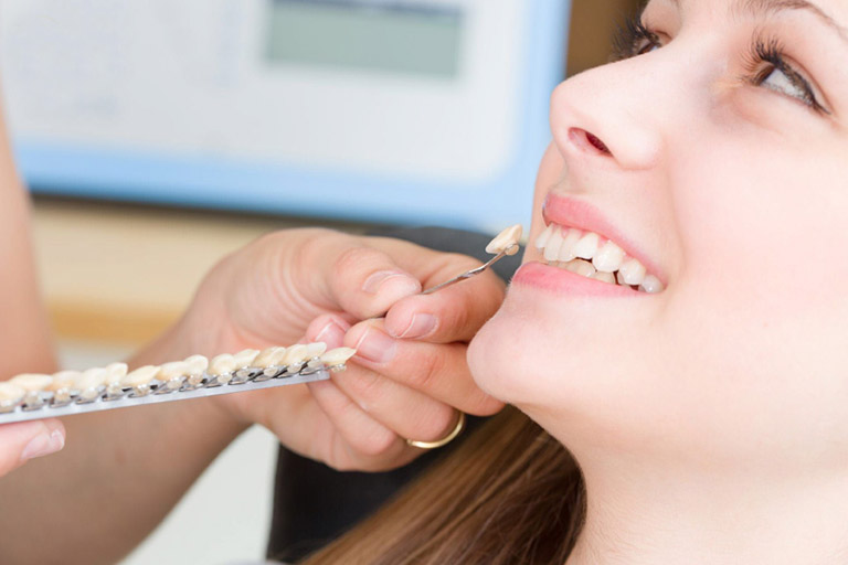 Phương pháp đắp Composite giúp trồng răng khểnh