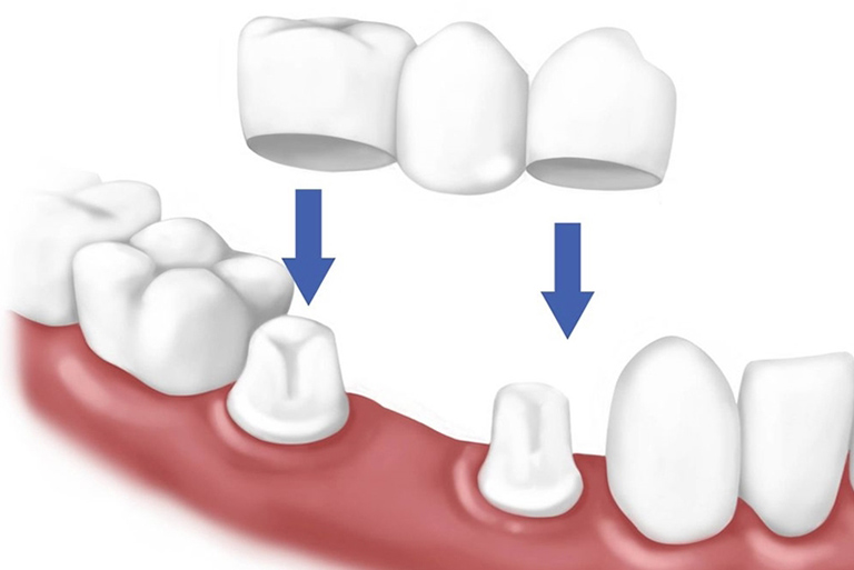 Trồng răng khểnh bằng phương pháp làm cầu răng sứ