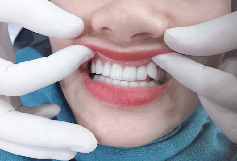 trồng răng khểnh bằng phương pháp bọc răng sứ