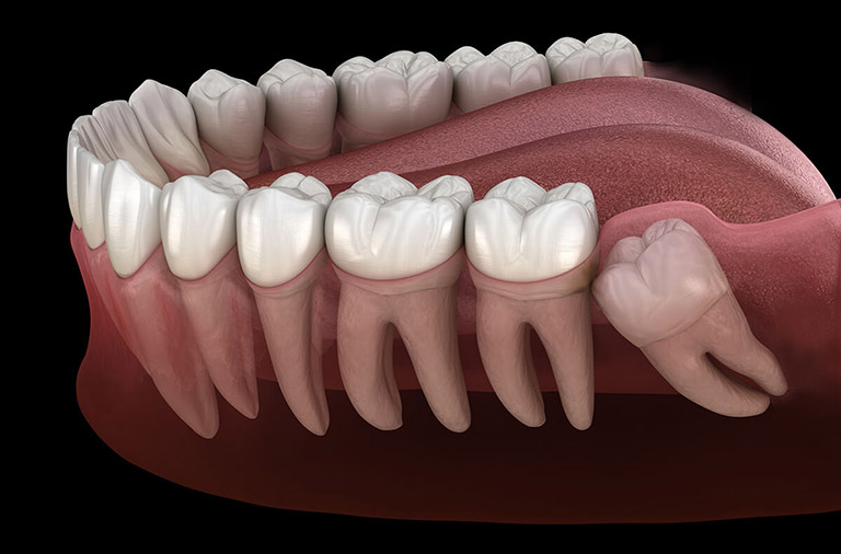 Viêm lợi trùm ở mức độ nhẹ và răng phát triển bình thường sẽ tự khỏi