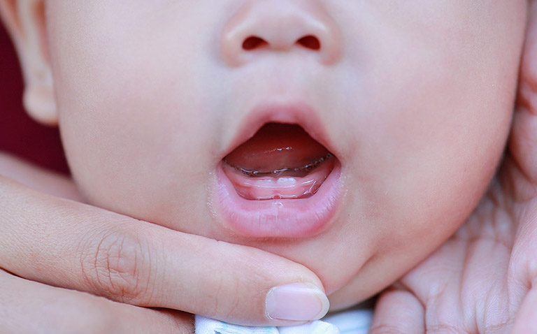 Viêm lợi trùm ở trẻ em thường liên quan đến quá trình mọc răng sữa