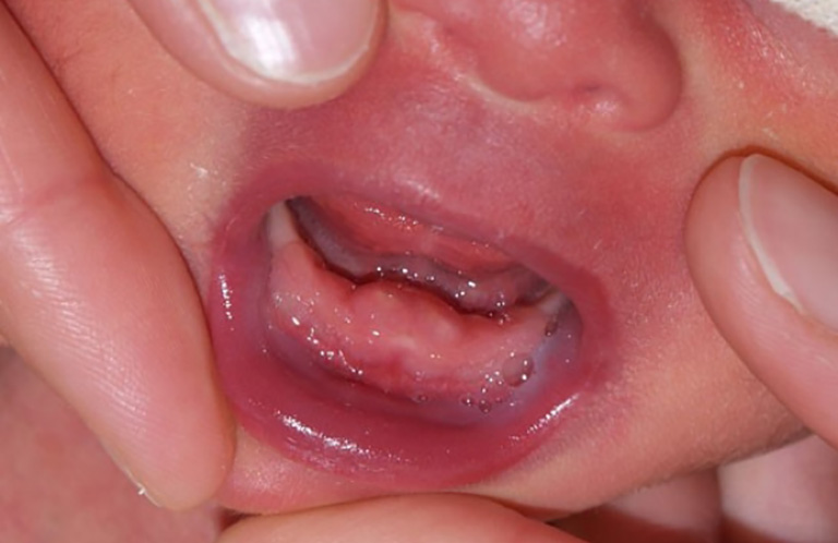 Viêm lợi trùm ở trẻ em khiến nướu răng sưng đỏ, phù nề