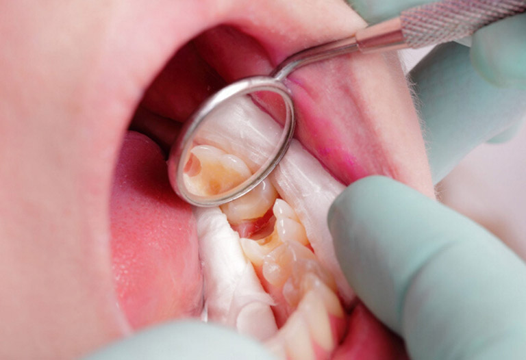 Sâu răng vào tủy gây hôi miệng khi tủy bị viêm và vi khuẩn phát triển mạnh