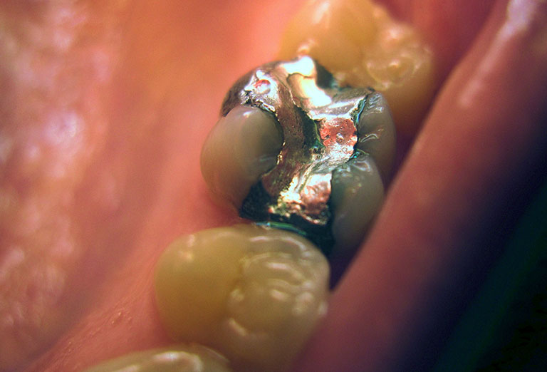 Răng sâu lỗ to có thể trám được nhưng miếng trám dễ bị rớt trong thời gian ngắn