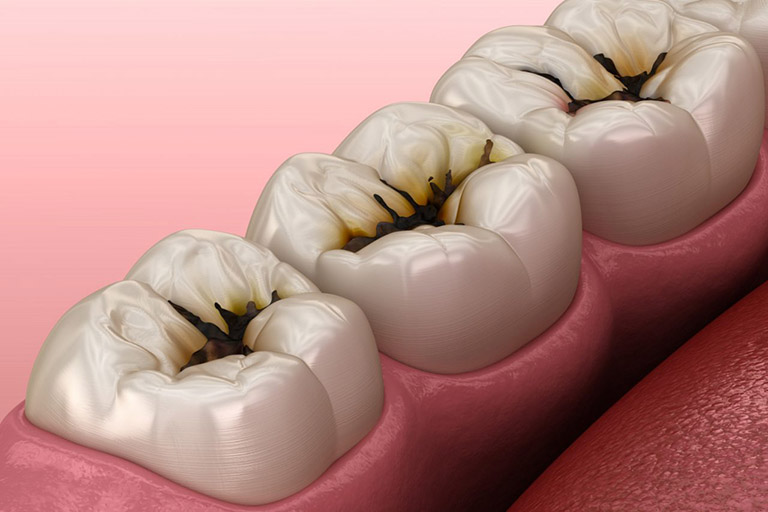Trám răng mang đến hiệu quả cao nhất cho người bị sâu răng nhẹ và vừa