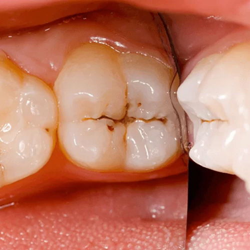 Sâu răng nhẹ là giai đoạn đầu của bệnh sâu răng