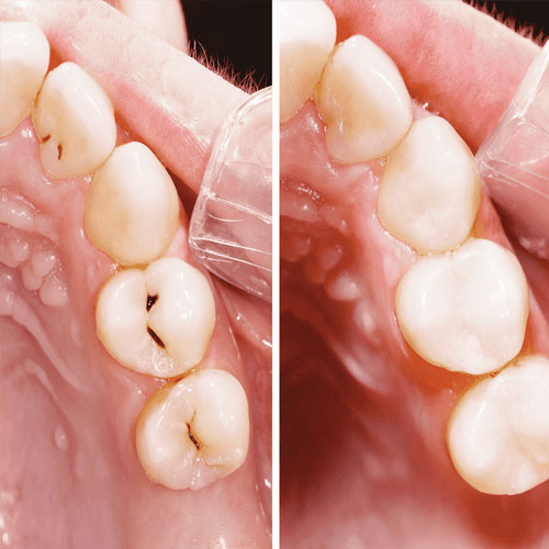 Trám răng được áp dụng trong việc chữa sâu răng nhẹ
