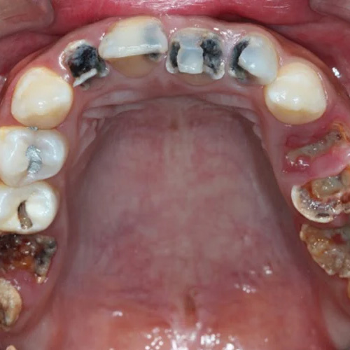 Các răng khấp khểnh, lệch lạc gây ra bệnh lý răng miệng