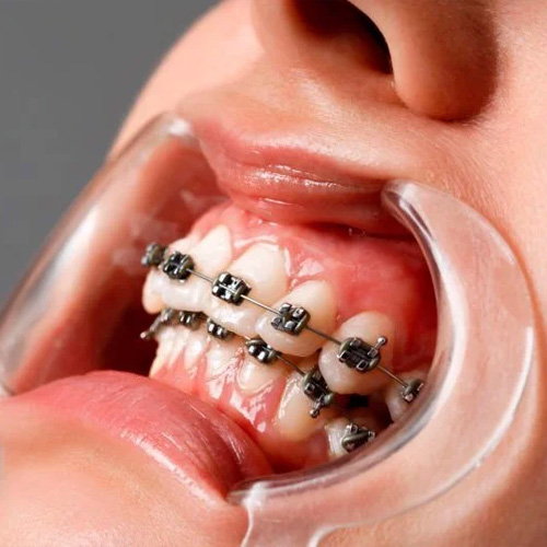 Niềng răng giúp bạn sở hữu cấu trúc hàm răng chuẩn