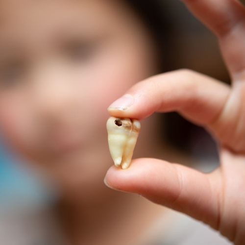 Sâu răng nặng thường do yếu tố vi khuẩn gây ra