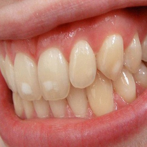 Khám nha khoa ngay khi thấy màu sắc răng thay đổi