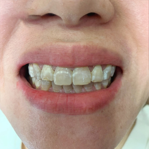 Răng nhiễm màu Tetracycline khiến hàm răng bị xỉn màu, ố vàng