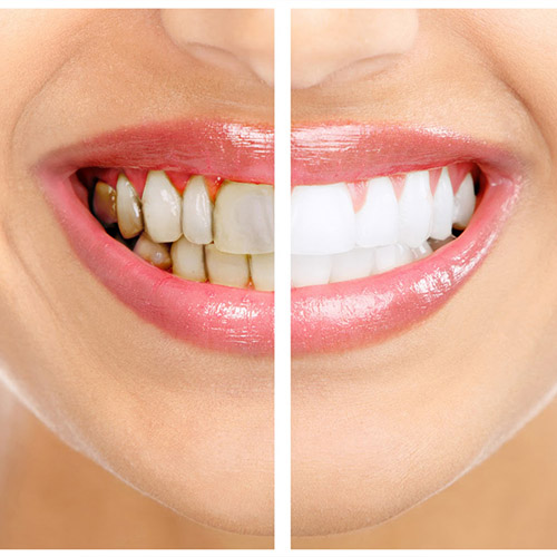 Thời gian làm trắng răng phụ thuộc vào nhiều yếu tố