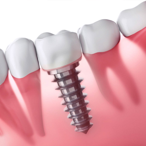 Trồng răng là phương pháp phục hình răng đã mất