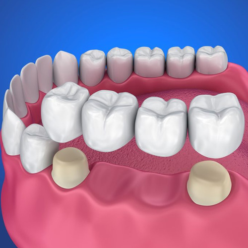 Trồng răng bắc cầu hay còn gọi là cầu răng sứ
