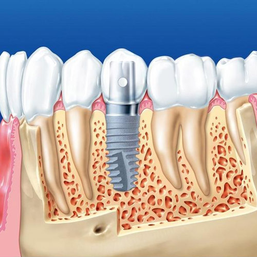 Cấy ghép Implant là phương pháp trồng răng hiện đại nhất hiện nay
