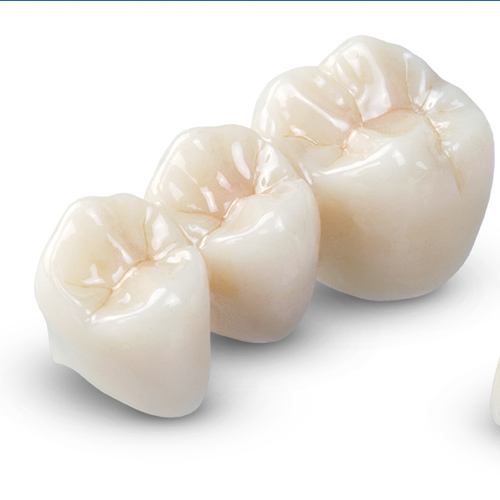 Răng sứ toàn sứ thường có chi phí cao hơn răng kim loại