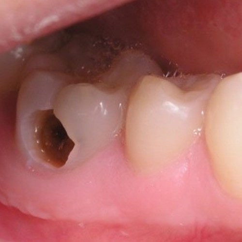 Lỗ sâu răng hình thành do nhiều nguyên nhân