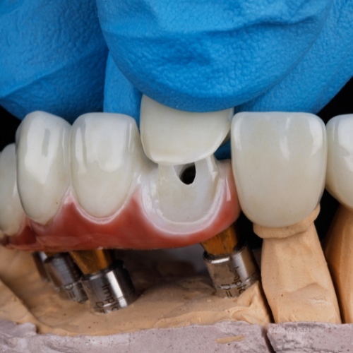Bọc răng sứ là cách trị lỗ sâu răng toàn diện nhất