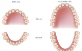 Phân biệt răng sữa và răng vĩnh viễn