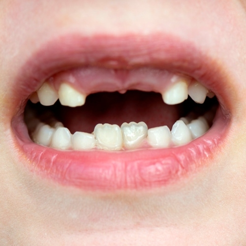 Quá trình thay răng của trẻ khi đến tuổi