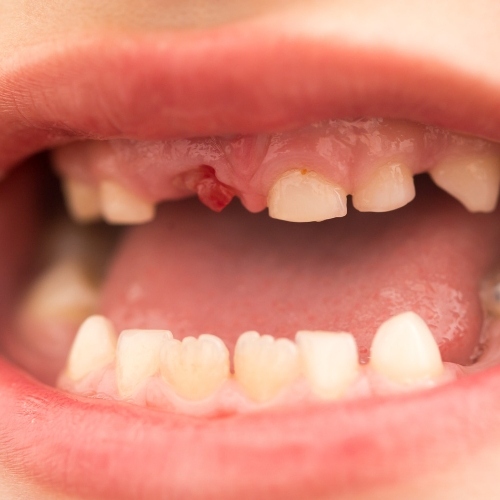 Trẻ thay răng theo tuần tự vị trí các răng