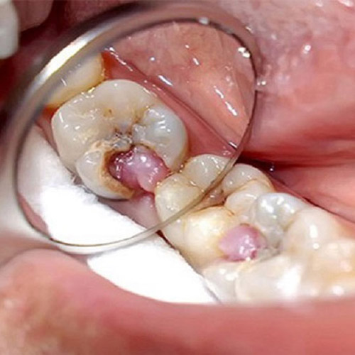 Sâu răng nếu không được xử lý có thể gây ra hiện tượng lồi thịt