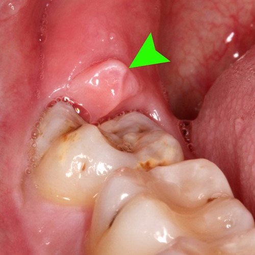 Răng sâu lồi thịt có thể gây áp xe răng