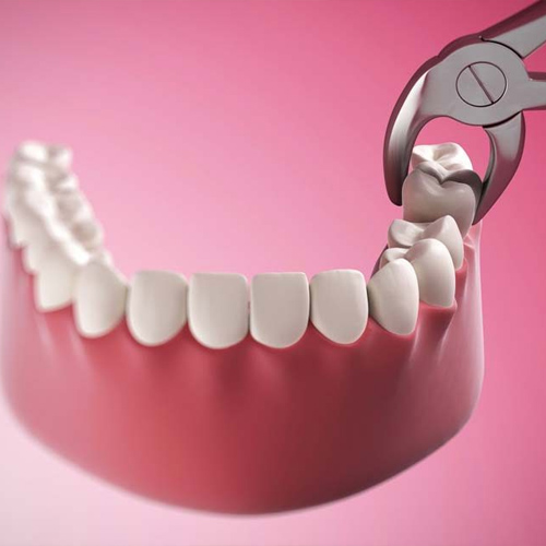 Nhiều trường hợp phải nhổ răng để tránh biến chứng