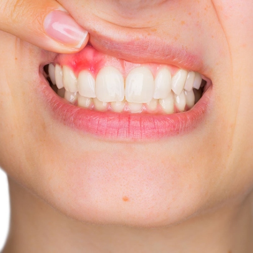 Lợi sưng đỏ kèm mủ là dấu hiệu dễ nhận thấy nhất khi bị sâu răng có mủ