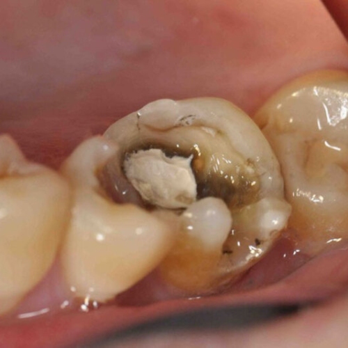 Sâu răng không được điều trị dẫn đến nhiễm trùng và xuất hiện mủ