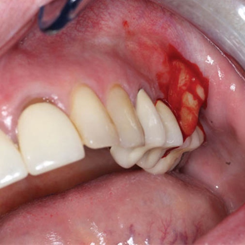 Viêm nha chu dẫn đến viêm tủy răng có mủ