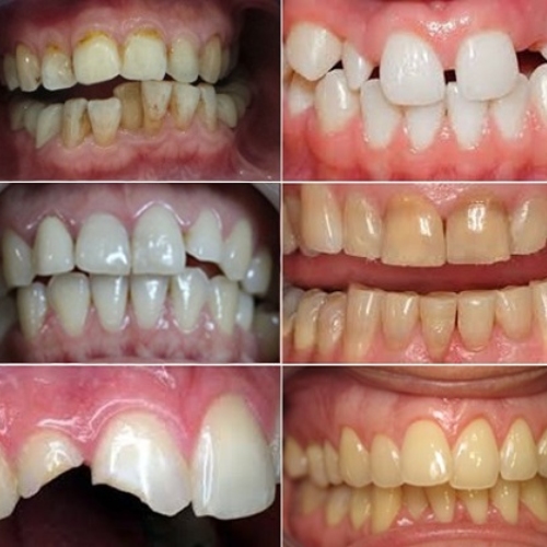 Những trường hợp nên bọc răng sứ để khôi phục tính thẩm mỹ
