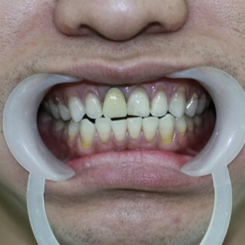 Bọc răng sứ bị thâm nướu do răng sứ kém chất lượng 
